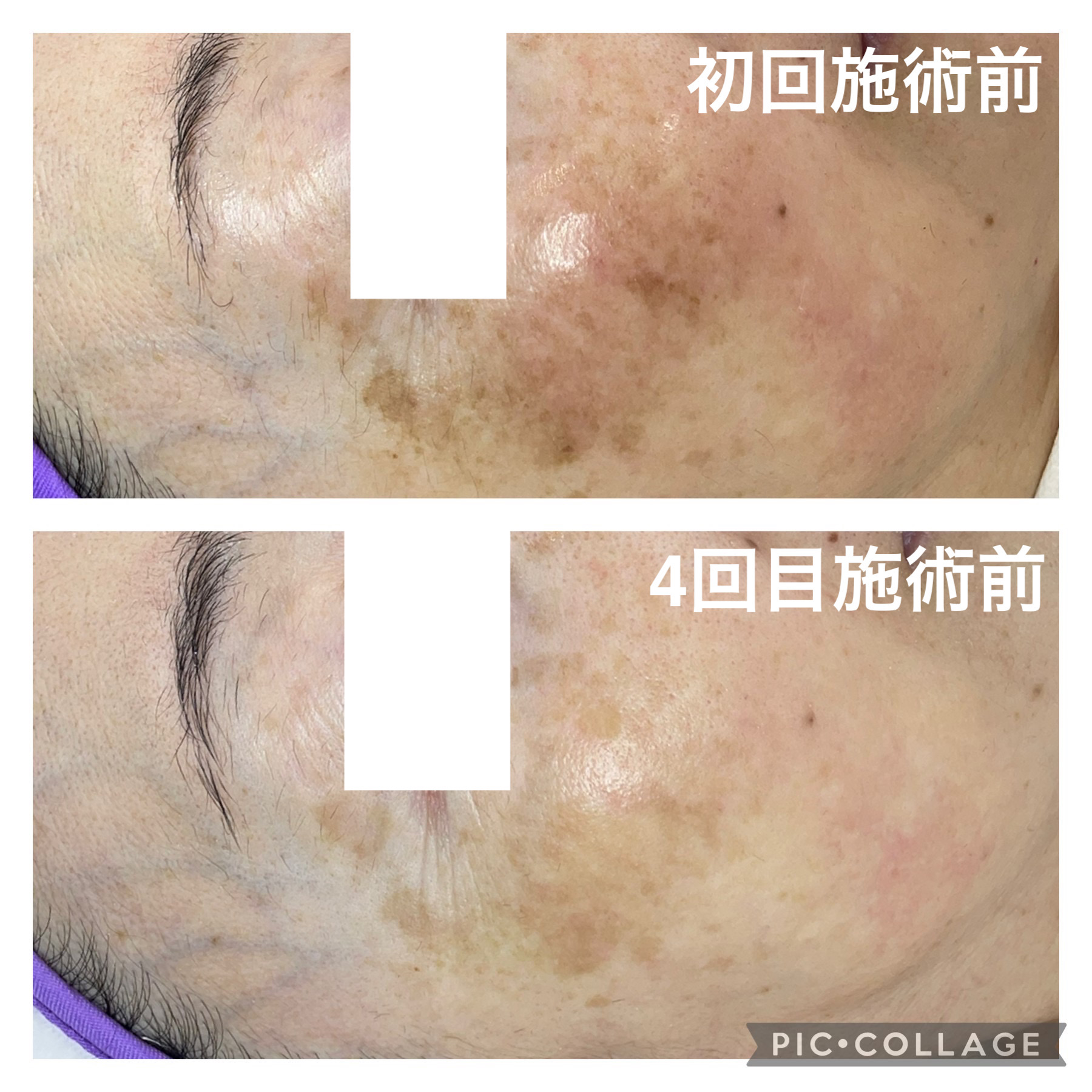 たった3回でシミがここまで薄くなる♪ | Si Belles(シベル)｜石川県